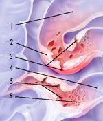 Morbo di Crohn